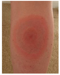 Lyme disease rash